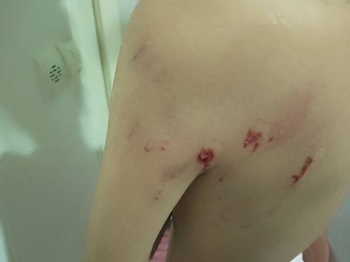 حمله سگهای بلاصاحب به دختر ۱۲ ساله در سنندج؛ زنگ خطر مدیریت شهری و مطالبه امنیت شهروندان